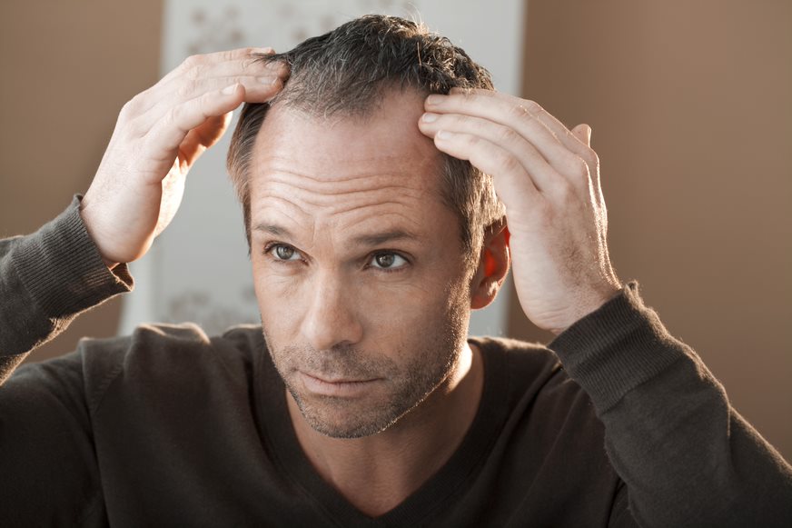 Alopecia Androgenética