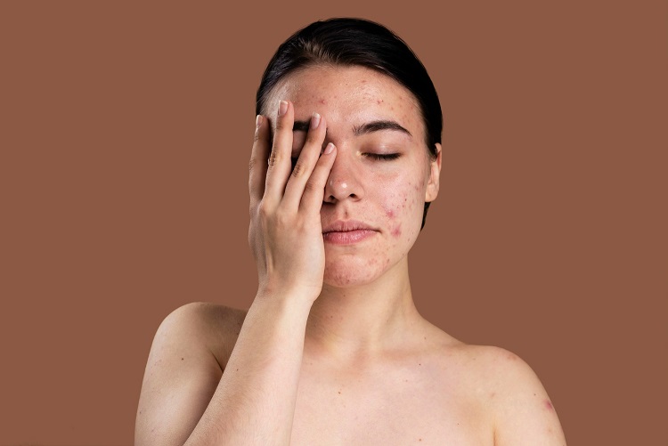 Melasma e Cloasma